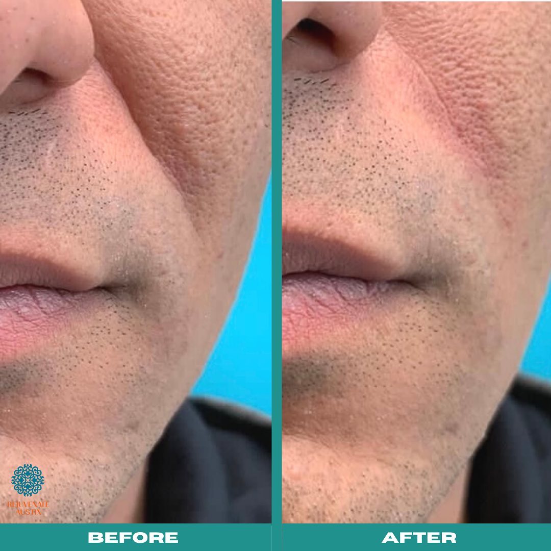 Botox being applied in Austin, TX