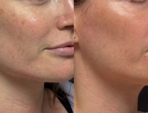 Why B.B.L. Photofacials Are the Secret to Radiant, Even – Toned Skin