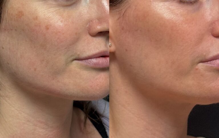 Why B.B.L. Photofacials Are the Secret to Radiant, Even - Toned Skin