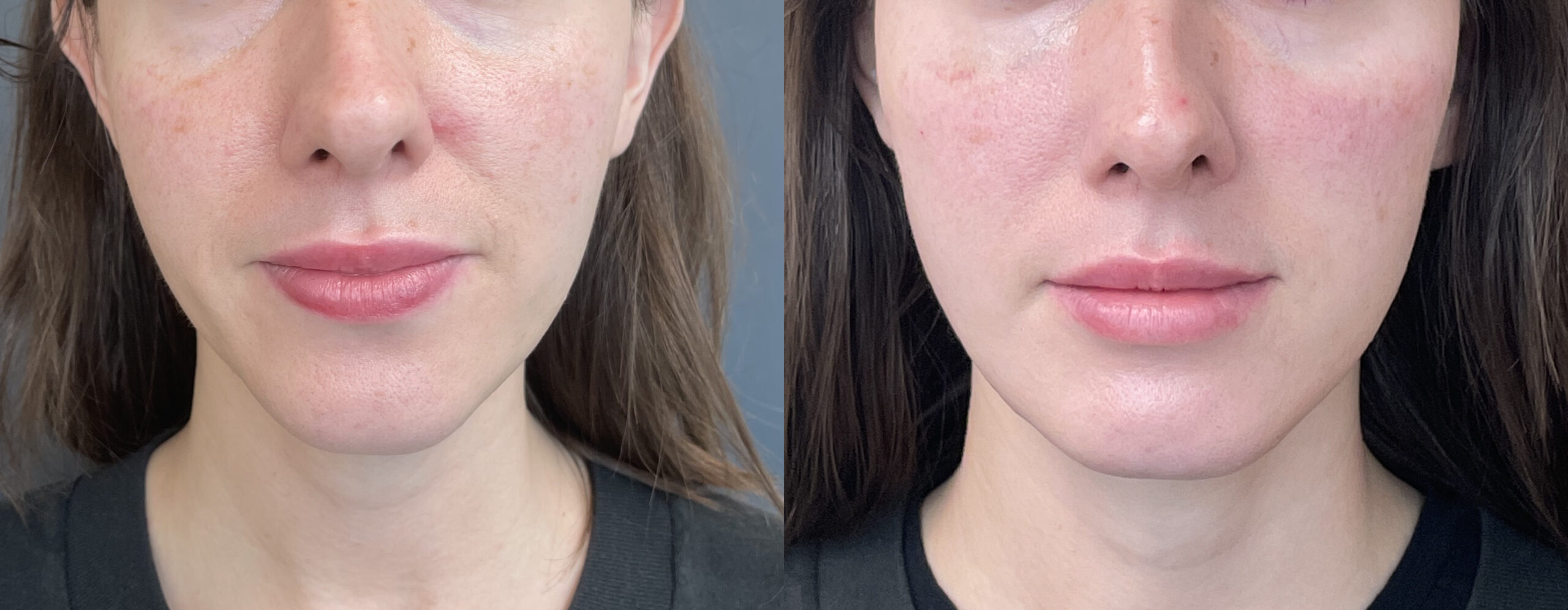 Subtle Facial Balancing: Enhancing Your Natural Beauty Without the Overdone