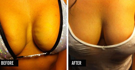 Vampire Breast Lift Before and After