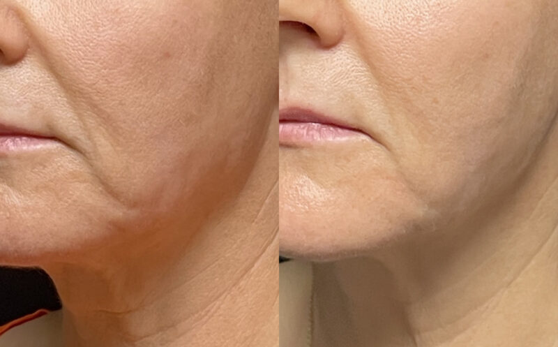 Ultherapy: A Non-Invasive Solution for Skin Tightening and Lifting