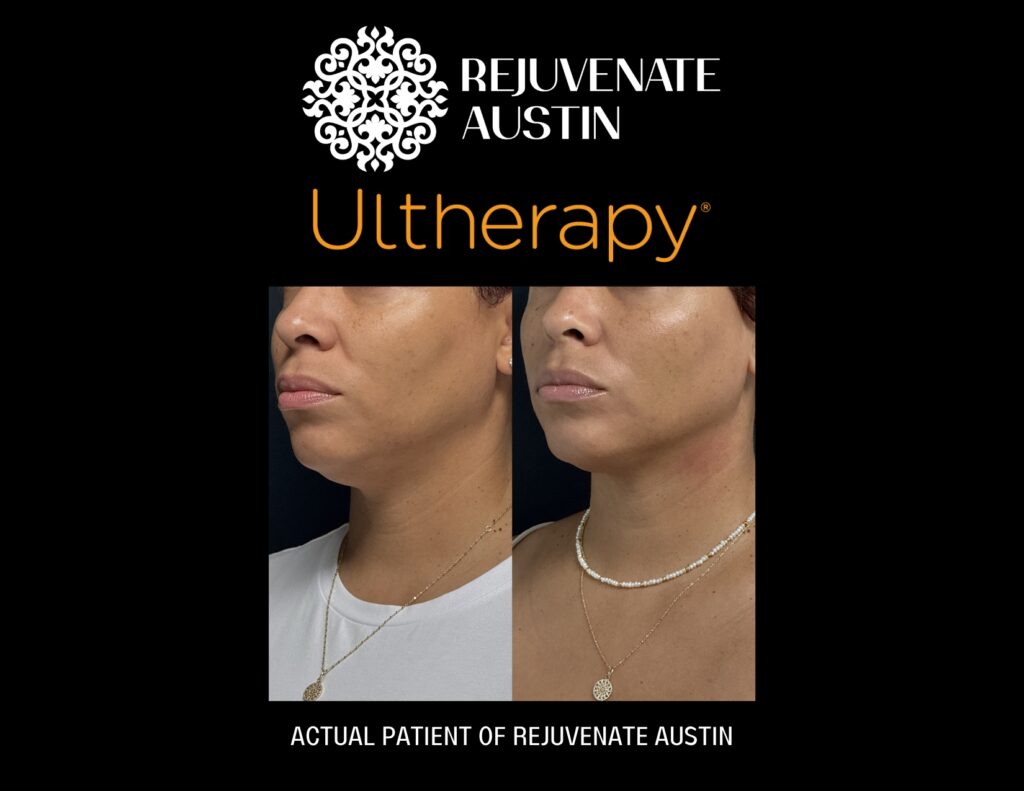 Ultherapy before and after chin