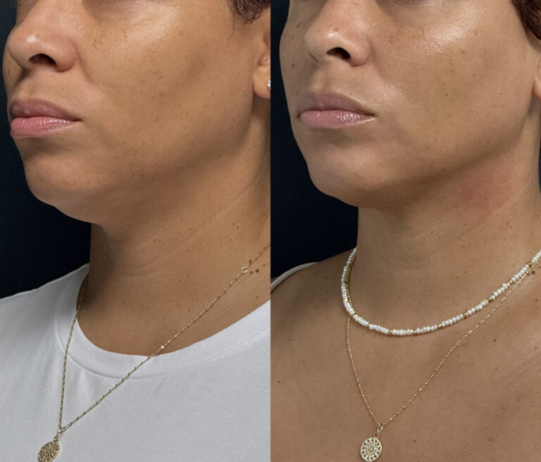 Ultherapy: A Non-Invasive Solution for Skin Tightening and Lifting