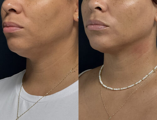 Ultherapy: A Non-Invasive Solution for Skin Tightening and Lifting