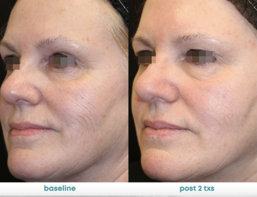 Summer Safe Skin Resurfacing: Achieve Radiant Skin All Year Round
